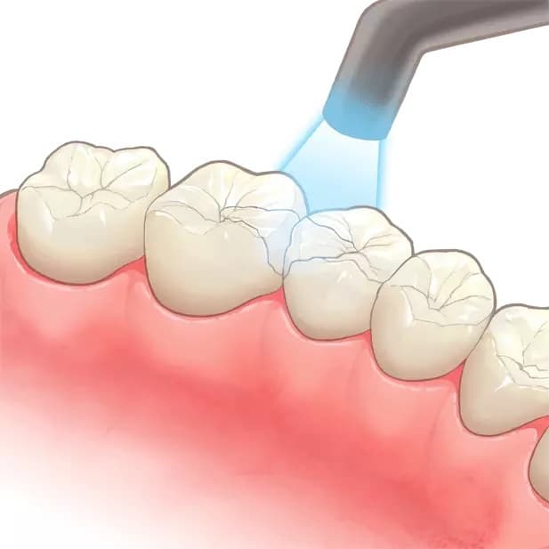 虫歯治療のイラスト