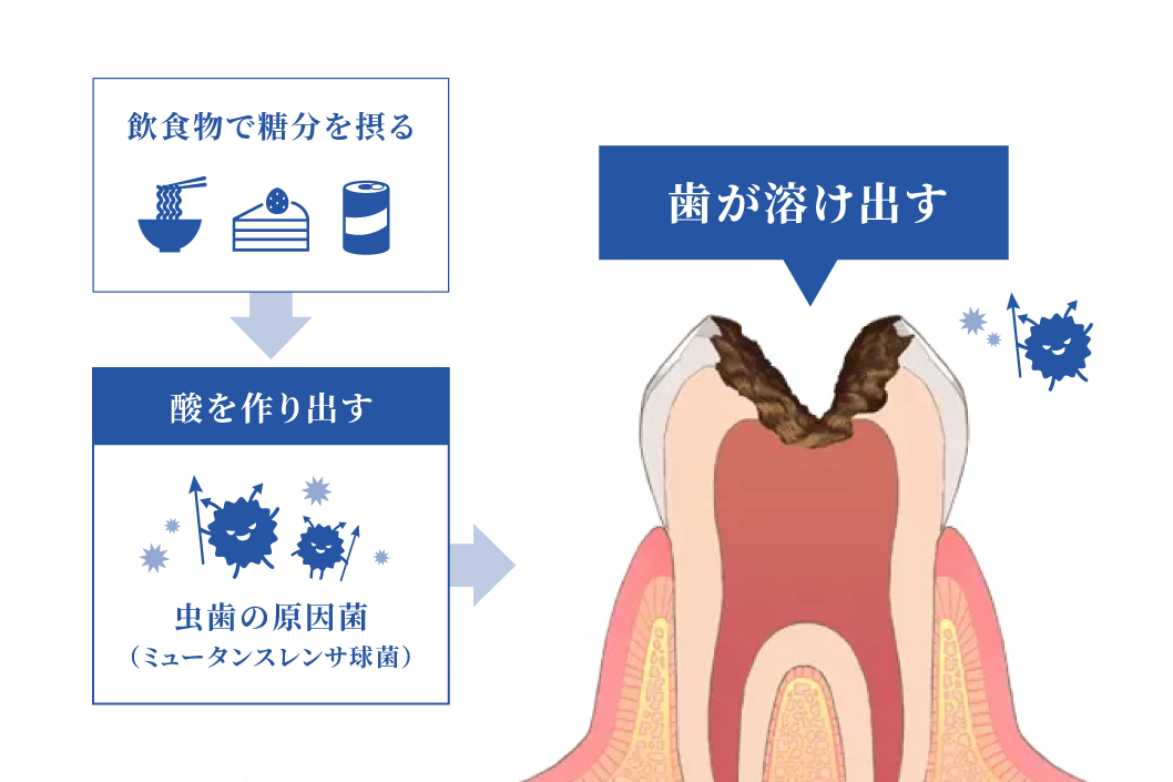 虫歯の仕組み
