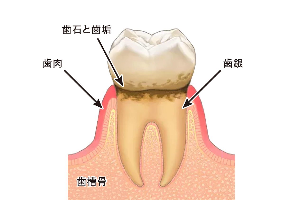 歯周病の図解