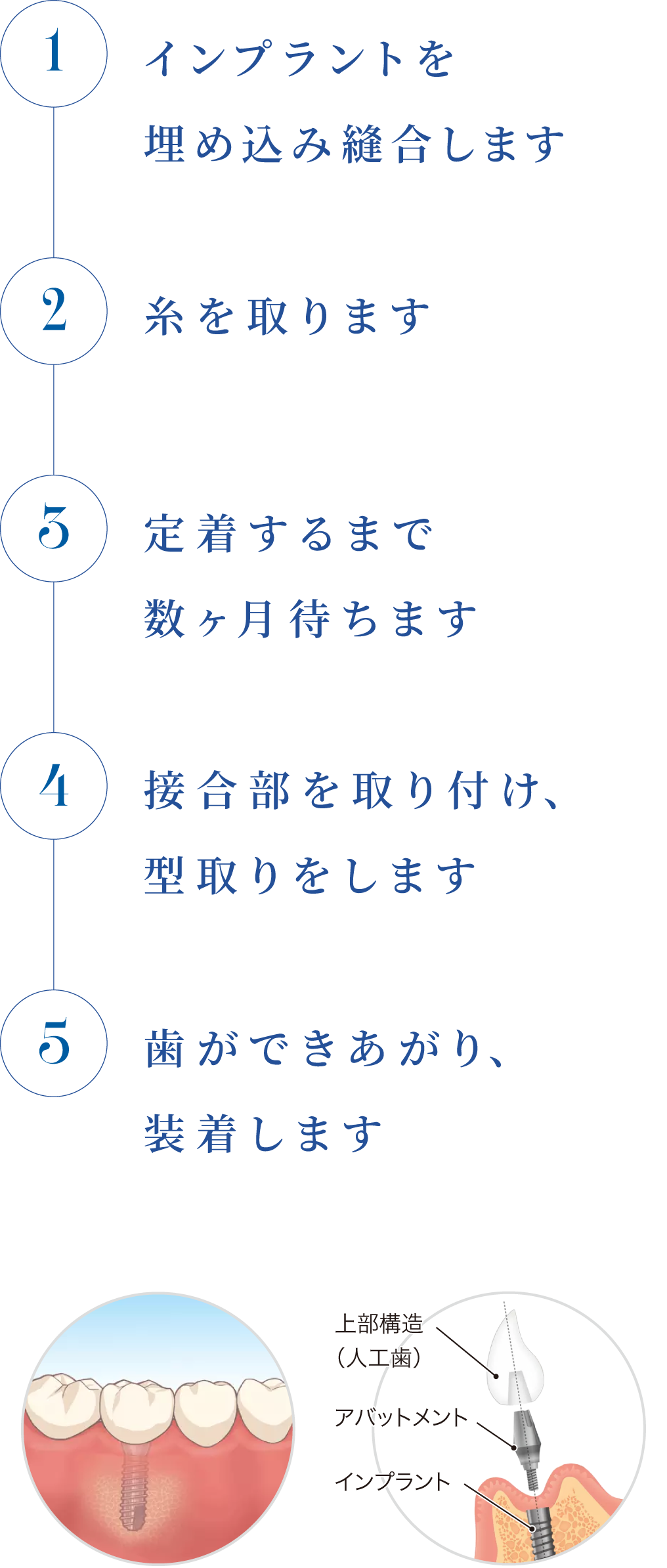 インプラント治療の流れ