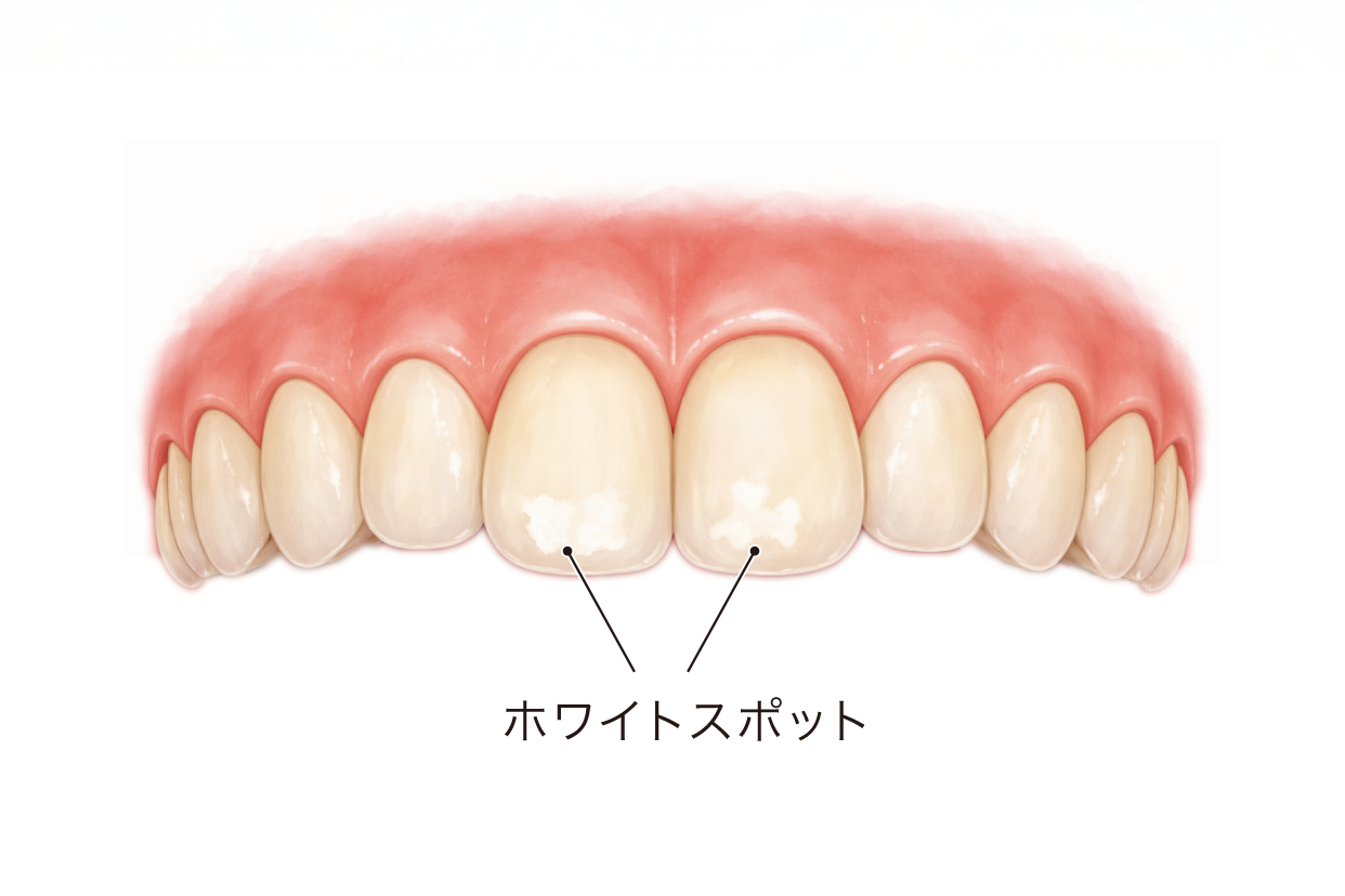 ホワイトスポットのイメージイラスト