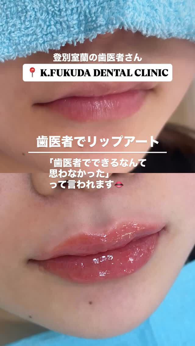 インスタ投稿_歯医者でリップアート